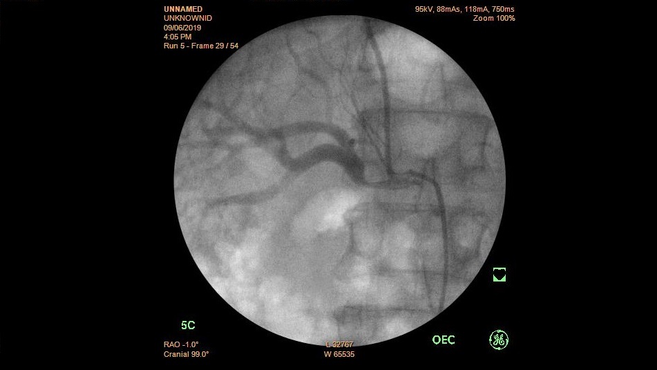 Nhân một trường hợp đặt stent động mạch thận kích thước lớn