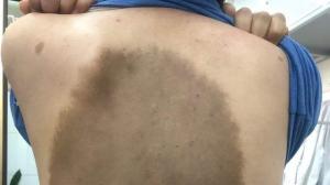 Mảng “da trâu” khổng lồ ở lưng được phẫu thuật điều trị thành công